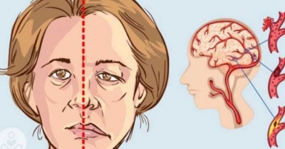 Alimente care reduc șansele de a te confrunta cu un atac cerebral