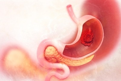 Cancer gastric: tipuri, simptome, cauze, tratament