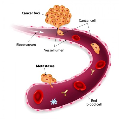 Cancer limfatic: cauze, simptome, tratament