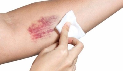 Cele mai eficiente remedii naturiste pentru tratarea vânătăilor