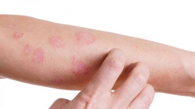 Cum ameliorezi simptomele date de psoriazis. Cele mai eficiente remedii naturiste