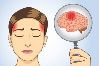 Cum poți să previi un accident vascular cerebral. Sfaturi de care să ții cont