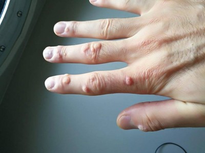 Cum să scapi de negi rapid și eficient, cu ajutorul unor remedii naturale