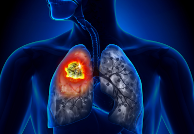 Cum știi că suferi de cancer la plămâni. Simptome pe care să nu le ignori