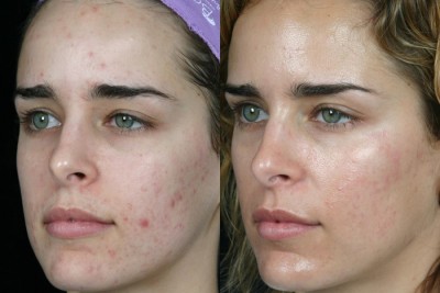 Remedii naturiste pe care trebuie să le încerci ca să scapi de petele și pistruii ce-ți dau bătăi de cap