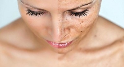 Remedii naturiste pentru a combate pistruii și petele de pe ten! Așa poți avea o piele curată