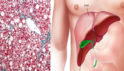 Remedii naturiste pentru ficat! Amestecul de legume ce ajută la combaterea toxinelor din ficat