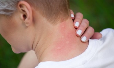 Remedii naturiste pentru înțepăturile de țânțari! Cum calmezi instant senzația de mâncărime