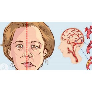 Alimente care reduc șansele de a te confrunta cu un atac cerebral