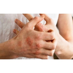 Alimente pe care trebuie să le consumi dacă ai psoriazis! Sunt vitale pentru pielea ta!