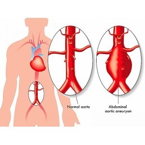 Anevrism aortic abdominal