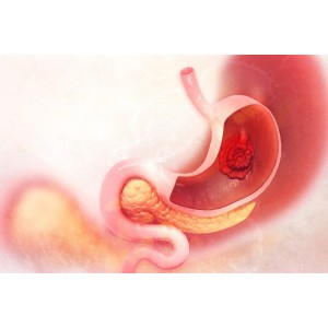 Cancer gastric: tipuri, simptome, cauze, tratament