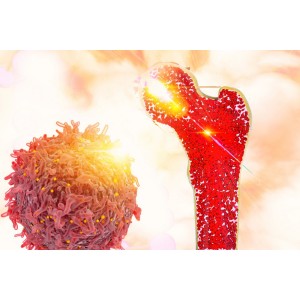 Cancer osos: ce este, tipuri, cauze, simptome, preventie, tratament