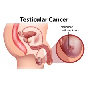 Cancer testicular: simptome, tratament