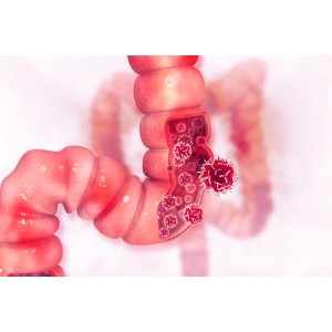 Cancerul de colon : cauze, simptome, diagnostic, tratament