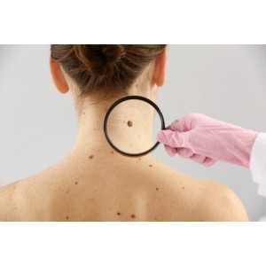 Cancerul de piele: cauze, simptome, tratament