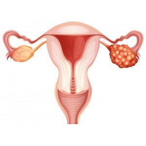 Cancerul ovarian: tipuri, cauze, simptome, diagnostic, tratament