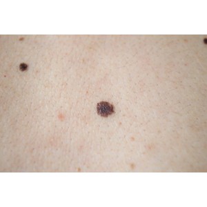 Cat traiesti cu cancer de piele