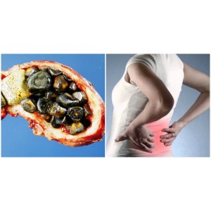 Ce alimente să consumi ca să previi formarea pietrelor la rinichi