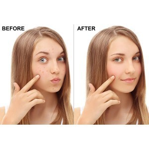 Cicatrici datorate acneei