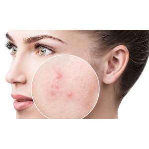 Combate acneea de la interior. Cele mai eficiente combinații de ingrediente ce ajută la combaterea coșurilor