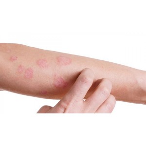 Cum ameliorezi simptomele date de psoriazis. Cele mai eficiente remedii naturiste