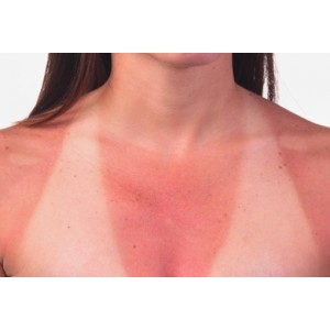 Cum combați arsurile solare! Remedii naturiste care îți vor ”răcori” pielea