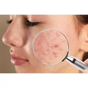 Cum să combați acneea cu ajutorul turmericului - remedii naturiste eficiente