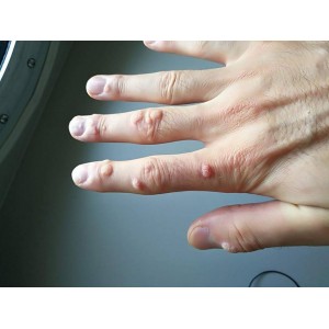 Cum să scapi de negi rapid și eficient, cu ajutorul unor remedii naturale