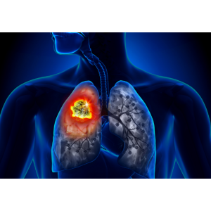 Cum știi că suferi de cancer la plămâni. Simptome pe care să nu le ignori