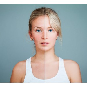 Dieta care combate rozaceea! Ce să mănânci ca să ai o piele frumoasă, lipsită de imperfecțiuni