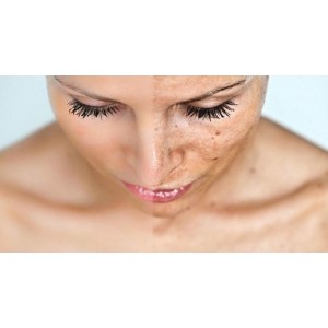 Remedii naturiste pentru a combate pistruii și petele de pe ten! Așa poți avea o piele curată