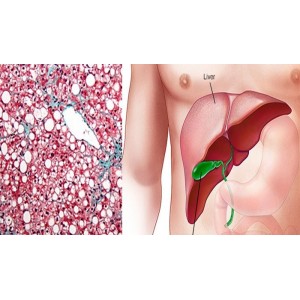 Remedii naturiste pentru ficat! Amestecul de legume ce ajută la combaterea toxinelor din ficat